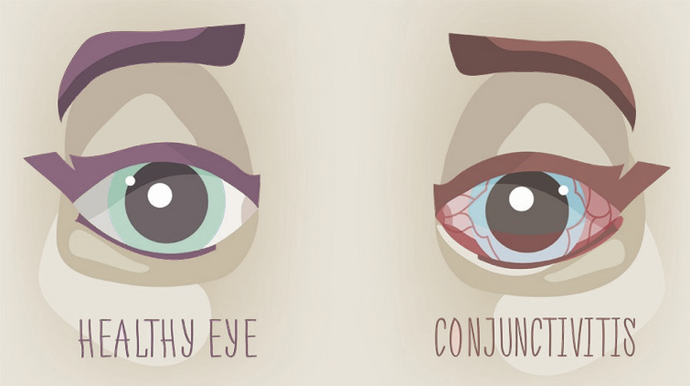 Conjunctivitis Symptoms and Causes