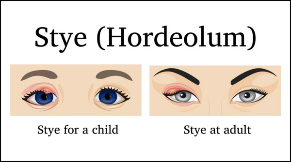 Top 3 Common Styes